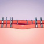 Ensuring Safety With Linear Cutting Staplers